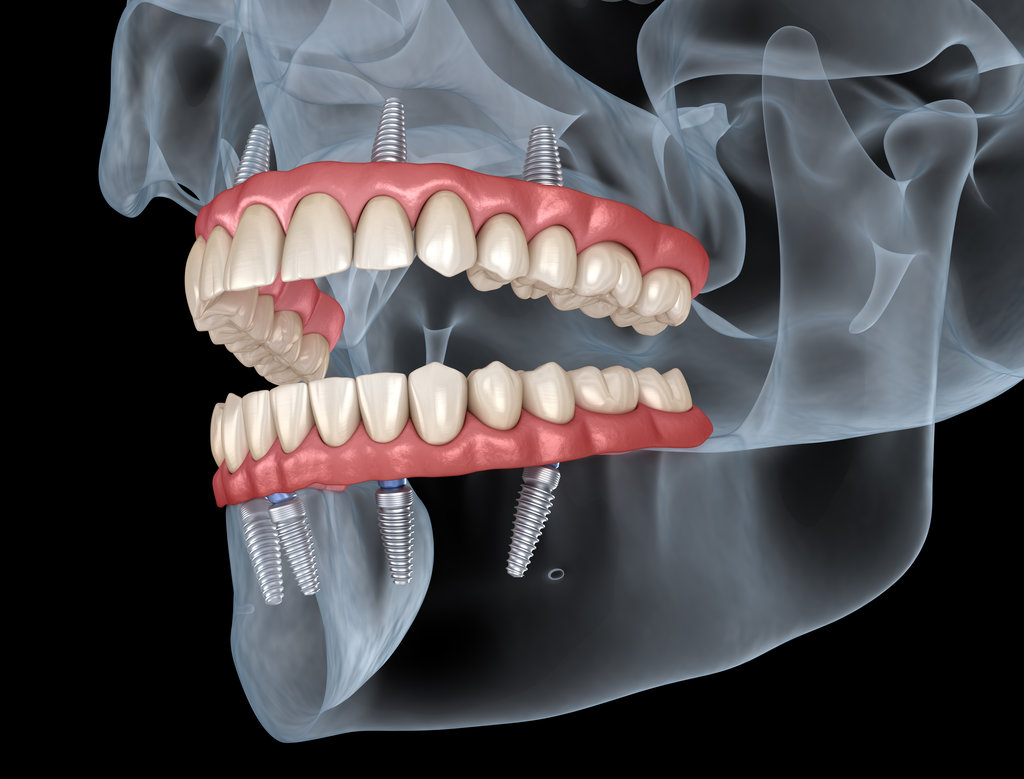 Maxillary and Mandibular prosthesis with gum All on 4 system supported by implants. Medically accurate 3D illustration of human teeth and dentures