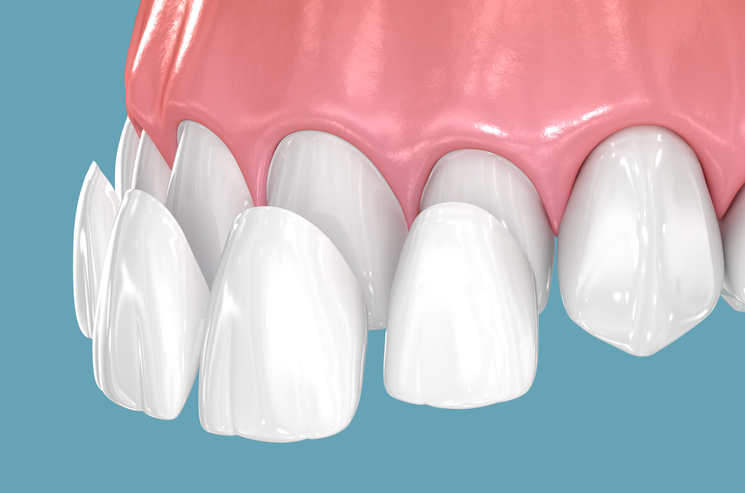 Dental veneers on blue background. 3D illustration